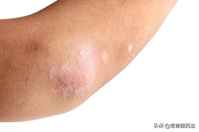 毛周角化症和银屑症