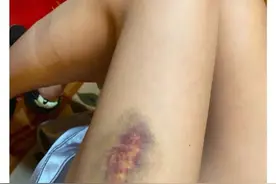 沈梦辰深夜发大腿受伤淤青照，看到杨迪回复，网友：海涛要吃醋了图片