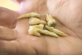 那种可以种植的牙有年龄限制吗？一个人最多种几颗？图片