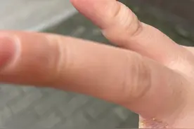 养猫后你是否也中招？猫癣怎么治？用药分享（人和猫得了猫癣）图片