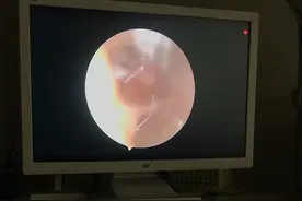 耳朵流脓有恶臭味，这个病破坏力太强图片