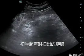 初学超声，胰腺为何总是扫不出来？图片