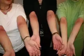 痧是什么？其实就是废弃的血，必须要排图片