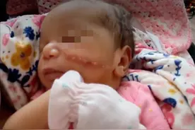 美国女婴剖腹产中脸颊被割伤，缝13针留明显疤痕，从鼻子蔓延至耳根图片
