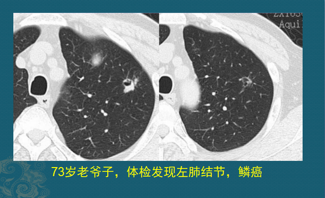 肺癌病理非角化型鳞癌