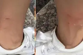 被狗咬伤后，仅注射狂犬疫苗是不够的图片
