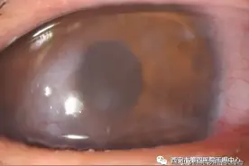 #健康中国行动2030# 总是眼痒、眼干、流泪？三种治疗方式来了解！图片