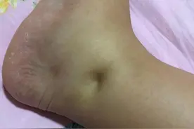怀孕几个月出现“脚肿”？孕期水肿有2种情况，7招缓解快收藏图片