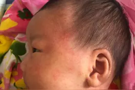 孩子得了湿疹不要急图片
