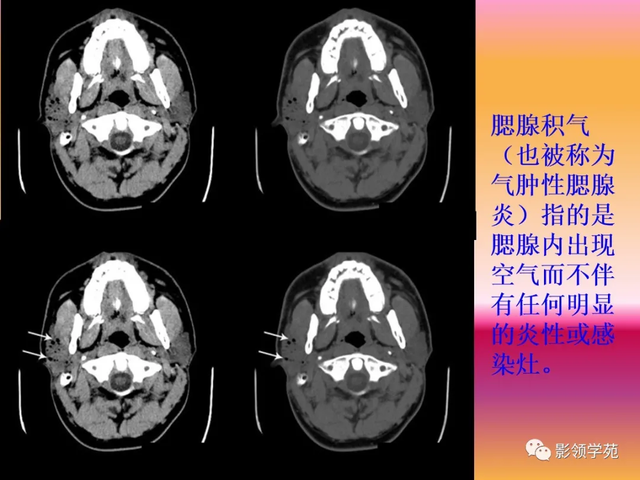 腮腺角化型鳞癌