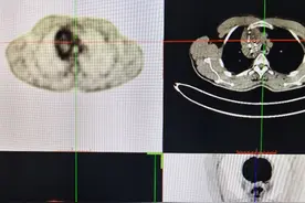 创新：125I粒子植入治疗甲状腺髓样癌图片