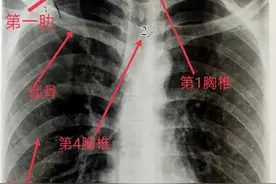 学习《X线读片指南》骨、关节系统——肋骨图片