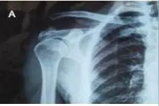 肩锁关节脱位研究：如何达到解剖复位和持续性稳定及关节微动图片