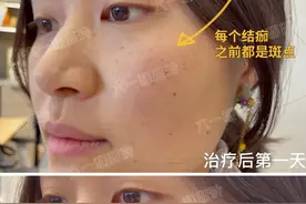 第一次打皮秒祛斑，我怎么没早打？图片