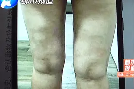 洛阳一女子花26000整容，3个月后：很恶心！感觉皮肤像蛤蟆一样！视频封面