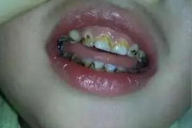 比糖还容易让宝宝"黑牙"三种食物，妈妈要注意，尽量别让孩子碰图片