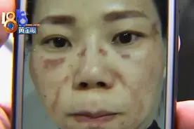 做祛斑越做越严重，医生说基本毁容了？图片