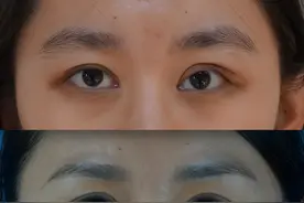 双眼皮手术中不能盲目做上睑下垂图片