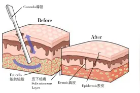 女网红抽脂后去世：减肥其实不用这么拼命也可以很高效图片
