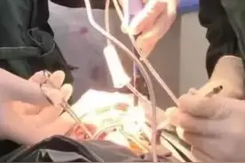 等离子手术治疗鼻炎~就在玉田县中医医院耳鼻咽喉科图片
