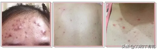 火爆INS的芝士皂，洗脸就像敷面膜，痘痘，黑头，螨虫全都消失了