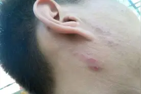得了神经性皮炎该怎么办？这个你可以用艾灸试试呀图片