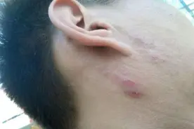 得了神经性皮炎该怎么办？这个你可以用艾灸试试呀图片