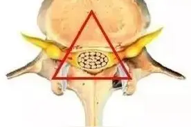 “我把腰闪了”，可能是腰椎小关节紊乱惹的祸图片