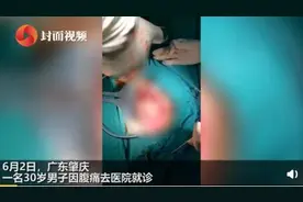 男子体内发现非洲鲫鱼：我不小心坐到鱼上了，鱼才从肛门进去的图片