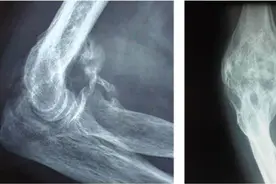 什么是异位骨化？图片