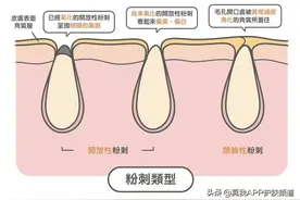 顽固黑头怎么去除！和草莓鼻头说再见图片