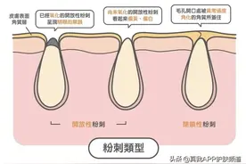 顽固黑头怎么去除！和草莓鼻头说再见图片