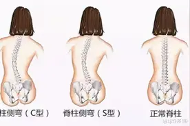 孩子“站没站相，坐没坐相”，要警惕颈椎侧弯毁终生图片