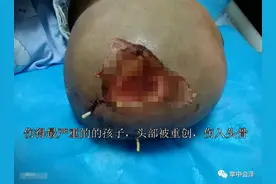 颅骨被咬穿，脸皮撕裂！会泽县野生猴子撕咬小学生 致多名孩子重伤图片