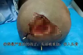 颅骨被咬穿，脸皮撕裂！会泽县野生猴子撕咬小学生 致多名孩子重伤图片