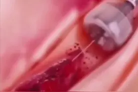 心肌梗死不用支架，只需把血栓抽出来就行了？专家辟谣：不要妄想图片
