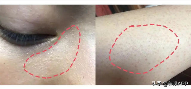 毛周角化会有黑点吗