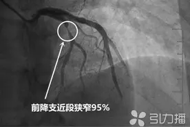 反复胸闷却硬撑 苏州一老伯险遭生命危险图片