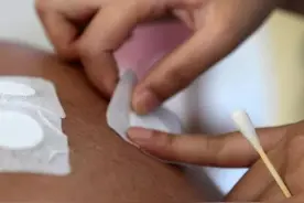 德化县医院康复科开展穴位贴敷，好评如潮图片