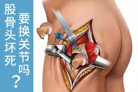 确诊股骨头坏死，就要考虑置换人工股骨头？医生告诉你别着急图片