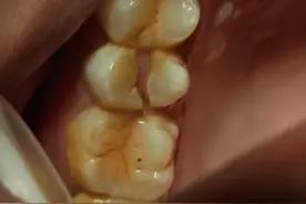 后悔！根管治疗后没做牙冠，结果吃东西时牙齿直接劈成两半图片