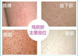 鸡皮肤毛周角化怎么消除