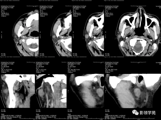 腮腺角化型鳞癌
