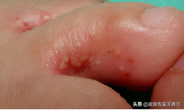 脚底表皮角化过度