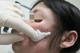 高新材料3D制作助力颧弓修复图片