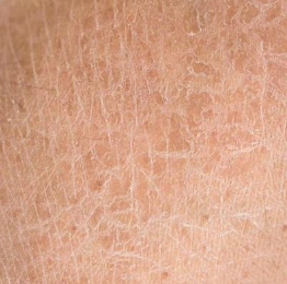 好大夫小腿痒鱼鳞病