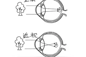 几张漫画让你看懂近视、远视、散光！图片