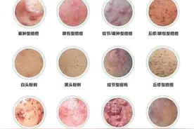 男性护肤小知识之痘痘图片