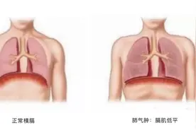 慢阻肺患者腹胀怎么办？5个小妙招来帮忙图片