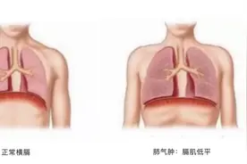 慢阻肺患者腹胀怎么办？5个小妙招来帮忙图片
